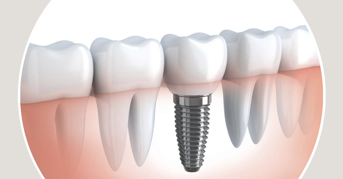 Implantologia dentária